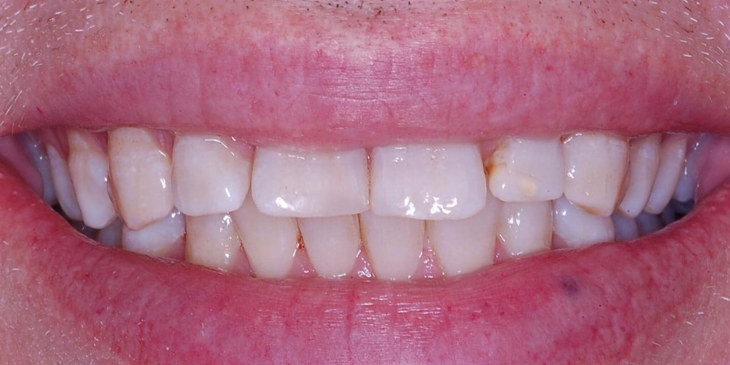 After teeth whitening in Burtonsville