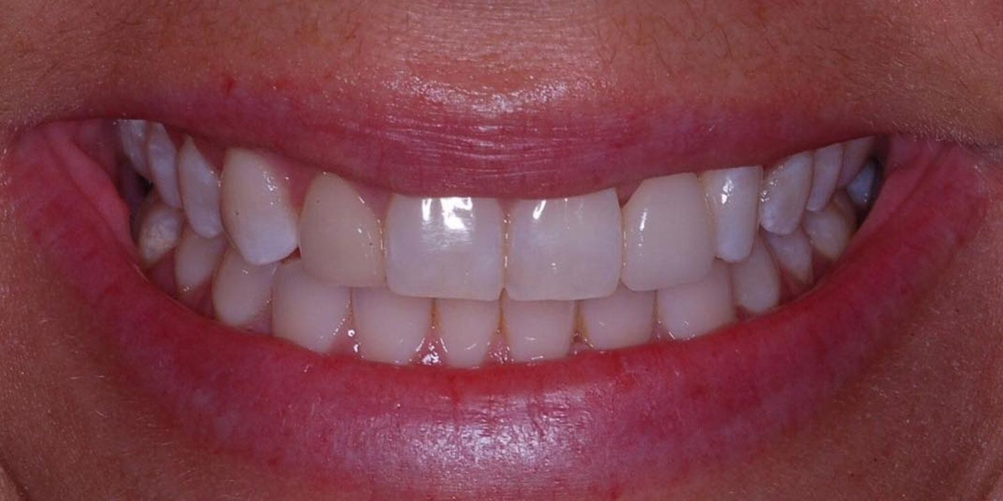 After teeth cleaning in Burtonsville