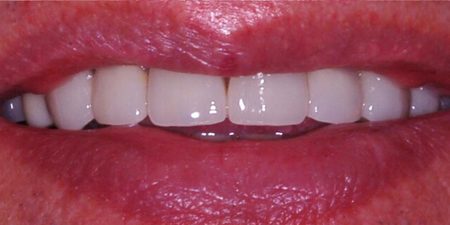 After smile makeover in Burtonsville