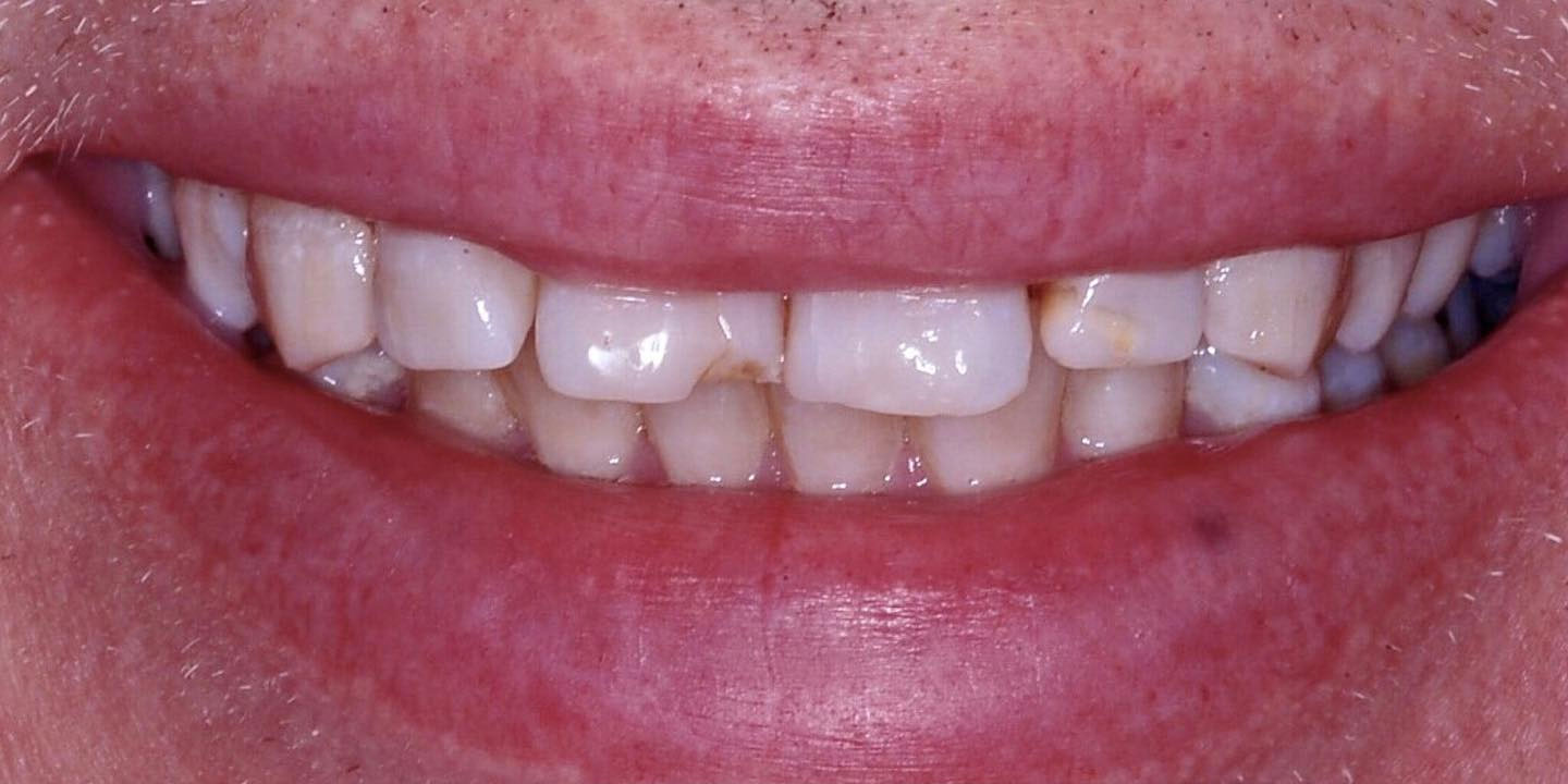 Before teeth whitening in Burtonsville