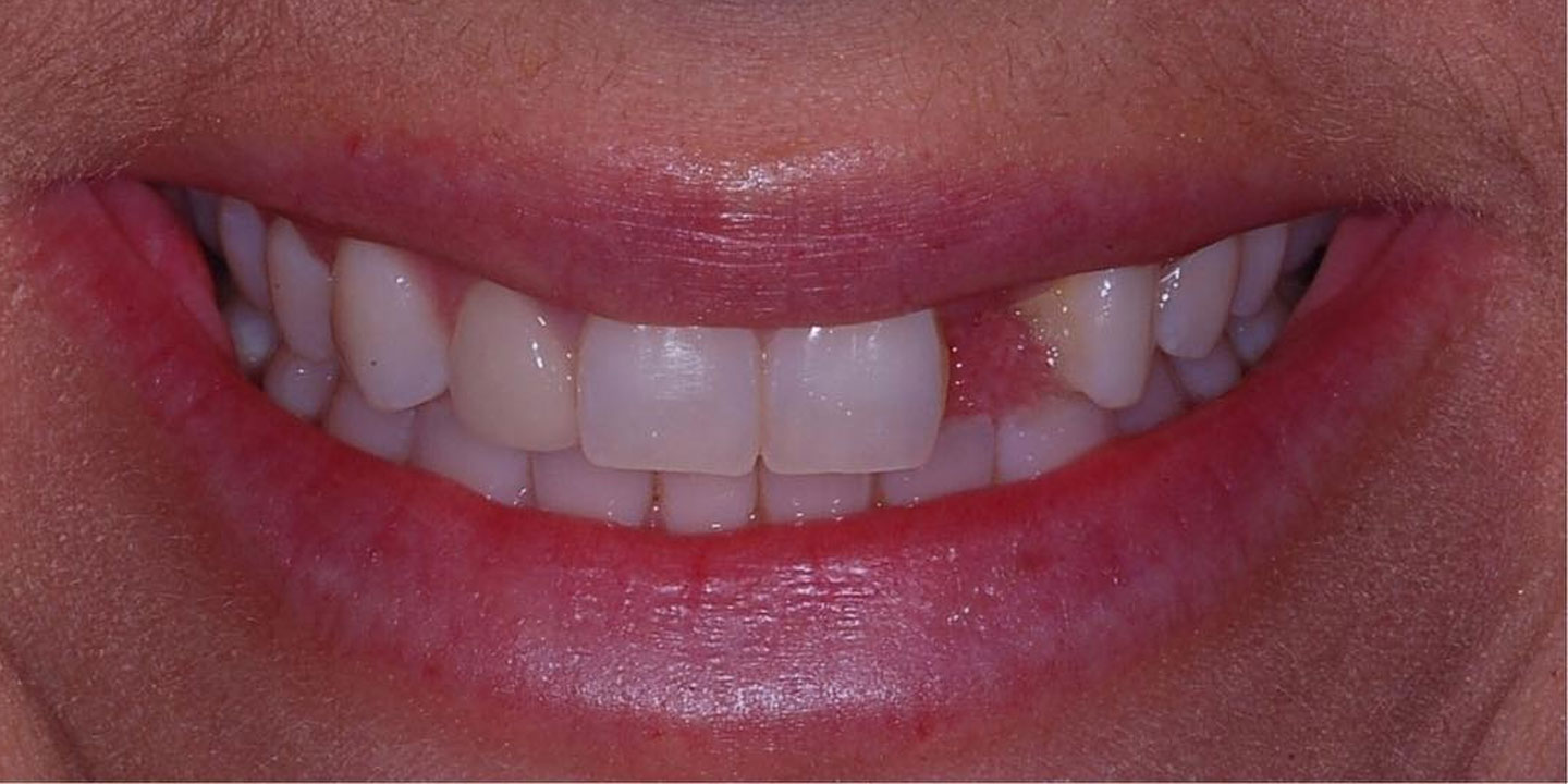 Before teeth cleaning in Burtonsville