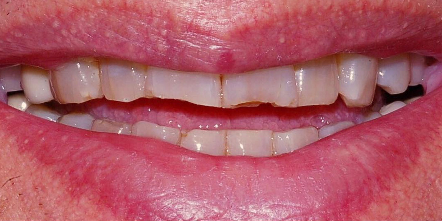 Before smile makeover in Burtonsville